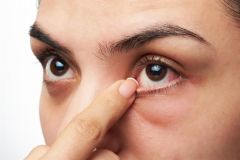 “سعود الطبية” توضح حقيقة استخدام القهوة في علاج متلازمة العين الجافة
