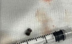 مستشفى بالقصيم ينقذ طفل اخترقت قلبه رصاصة أثناء عبثه ببندقية