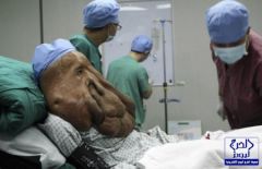 بالصور.. “الرجل الفيل” يخضع لجراحة لإزالة 3 أورام من وجهه