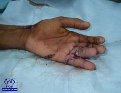 فريق طبي يقوم بترميم أصابع عشريني في مستشفى الملك فهد