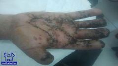 فريق طبي بمستشفي الملك خالد ينقذ يد سعودي تهتكت من الألعاب النارية