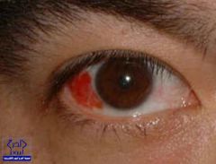العلامات الشائعة لأمراض العيون الخطيرة