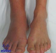 العلامات والأعراض الدالّة على جلطة الساق