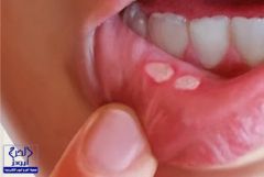 باحثون أمريكيون يكشفون أسباب ظهور قرح الفم وطرق علاجها
