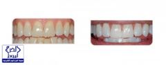 أسباب مختلفة لاصفرار الأسنان.. تعرف عليها قبل التبييض