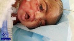 وفاة طفلة الجلد الفقاعي “جوري” .. ووالدها يفجِّر مفاجأةً مدوية