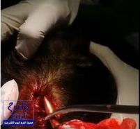 بالصور.. فريق طبي بمستشفى بيش يستخرج رصاصة من رأس طفلة دون عملية
