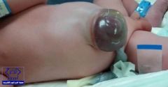 في حالة نادرة.. إنقاذ مولود يعاني من بزوغ بالكبد في مستشفى سكاكا
