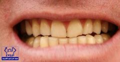 6 أسباب لا تعرفها تؤدي إلى «اصفرار الأسنان»