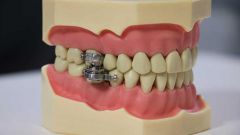 ابتكار جهاز “قفل الأسنان” لمساعدة المصابين بالسمنة على فقدان الوزن.. وهذه فكرته