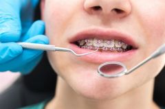 “سعود الطبية” توضح أهمية مثبت تقويم الأسنان الداخلي الثابت وطرق المحافظة عليه